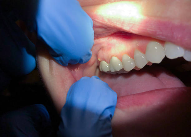 Best Emergency Gum Treatment in West Sand Lake, NY
