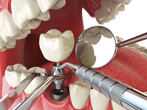 Best Emergency Tooth Extraction in West Sand Lake, NY